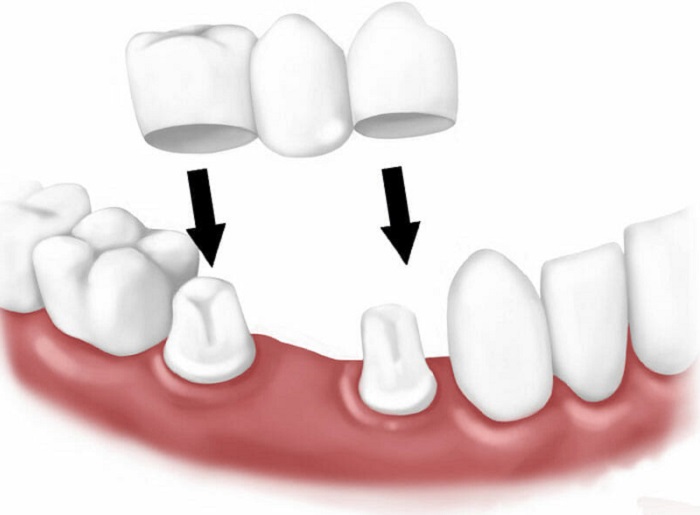 Cầu răng sứ cũng có rất nhiều ưu điểm